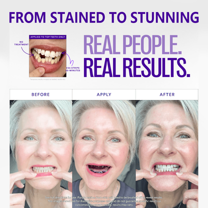 SmileFitPro™ V36 Whitening Strips – Professional Teeth Whitening at Home