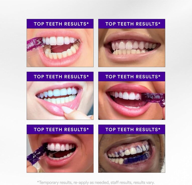 whitening-strips-the-fast-track-to-a-stunning-smile-7829